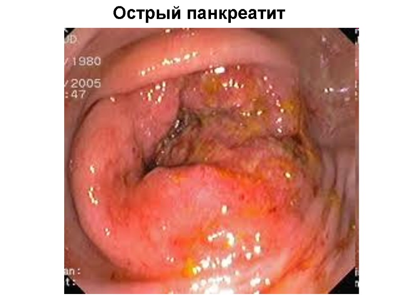 Острый панкреатит